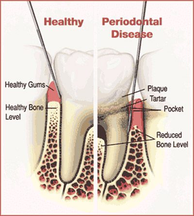 Fine Periodontics Your Periodontist in Greenville and Anderson SC and surrounding areas image dental - Gum Disease